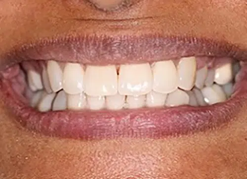 After photo of Inman Aligner treatment at Aloe Vera Dental in Chelmsford Essex