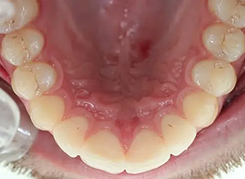 After photo of Inman Aligner treatment at Aloe Vera Dental in Chelmsford Essex