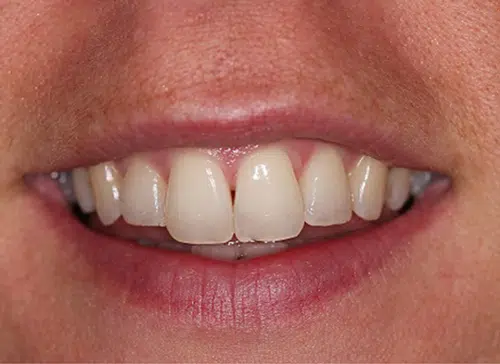 After photo of Inman Aligner treatment at Aloe Vera Dental in Chelmsford Essex