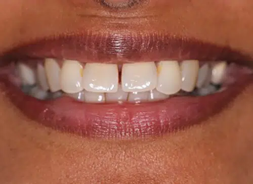 Before photo of Inman Aligner treatment at Aloe Vera Dental in Chelmsford Essex