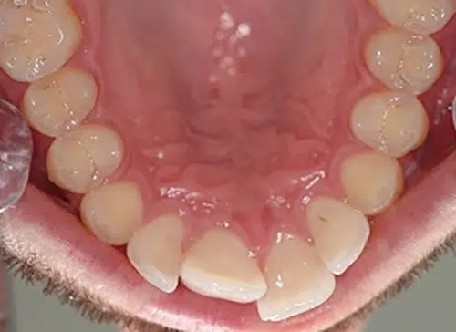 Before photo of Inman Aligner treatment at Aloe Vera Dental in Chelmsford Essex
