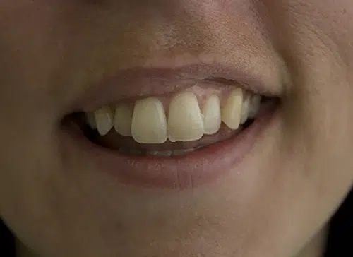 Before photo of Inman Aligner treatment at Aloe Vera Dental in Chelmsford Essex