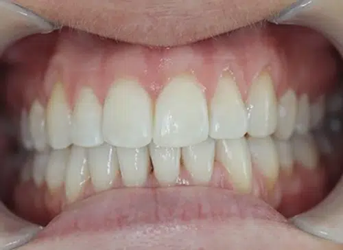 After photo of Six Month Smiles treatment at Aloe Vera Dental in Chelmsford Essex
