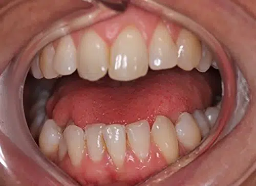 Before photo of Six Month Smiles treatment at Aloe Vera Dental in Chelmsford Essex