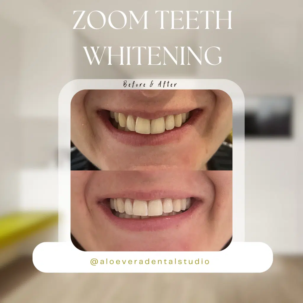 teeth whitening chelmsford essex