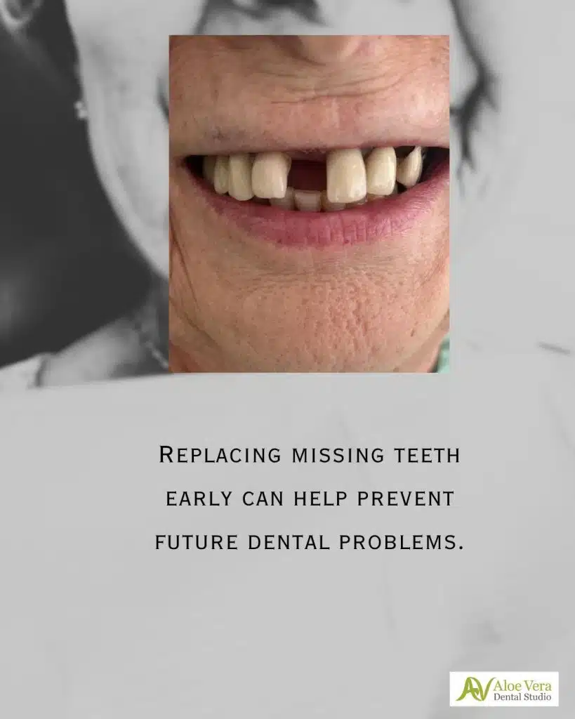 dental implants