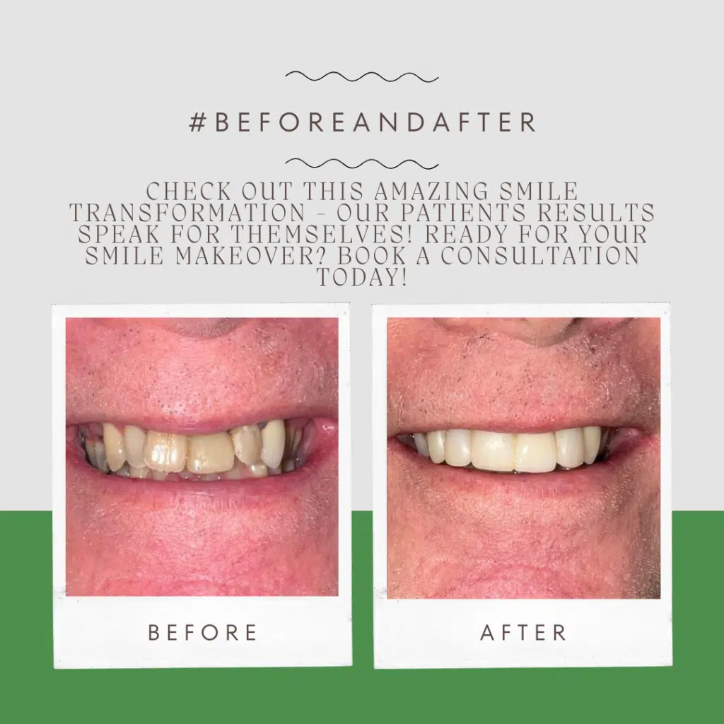 dental veneers