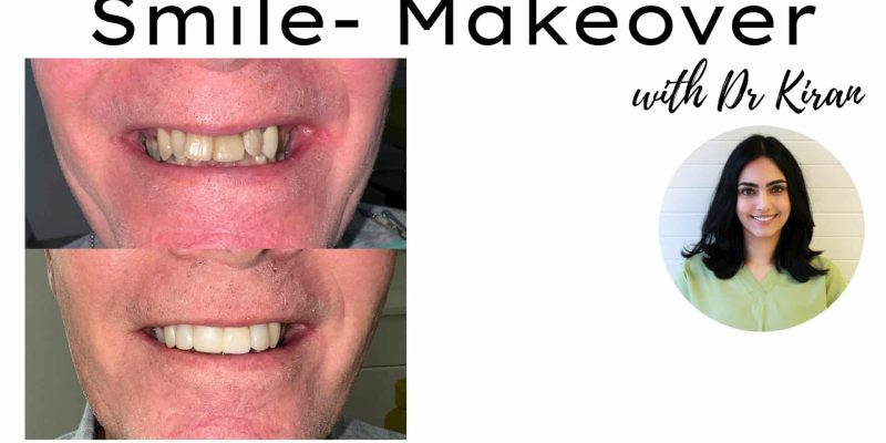 Smile Makeover with Dr Kiran Dentist Chelmsford