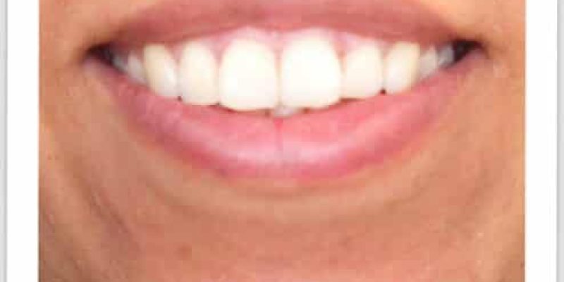 invisalign